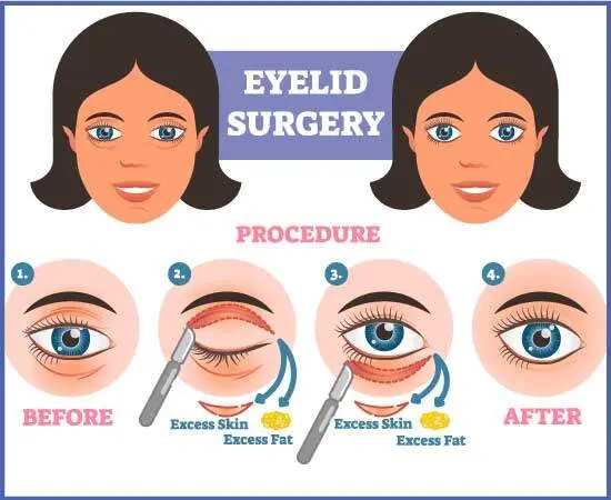 Göz Kapağı Ameliyatı / Blefaroplasti