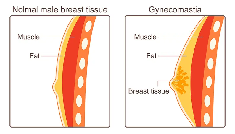 Gynäkomastie / Brustverkleinerung bei Männern