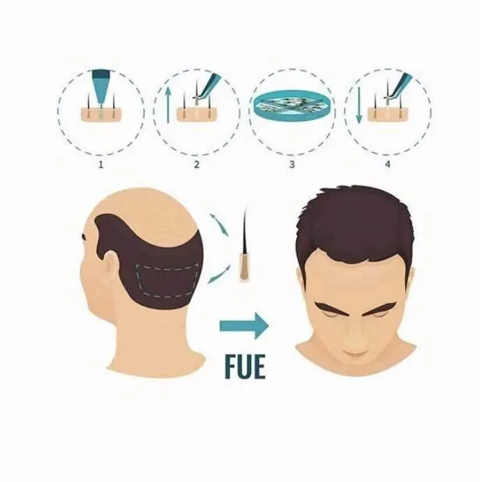Follicular Unit Extraction (FUE) Haartransplantation