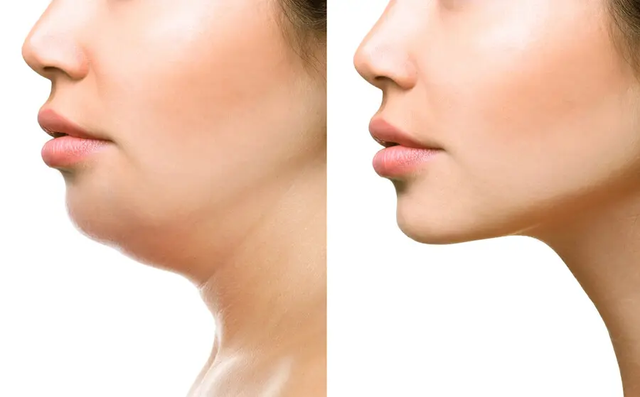 Chin Augmentation / Genioplasty