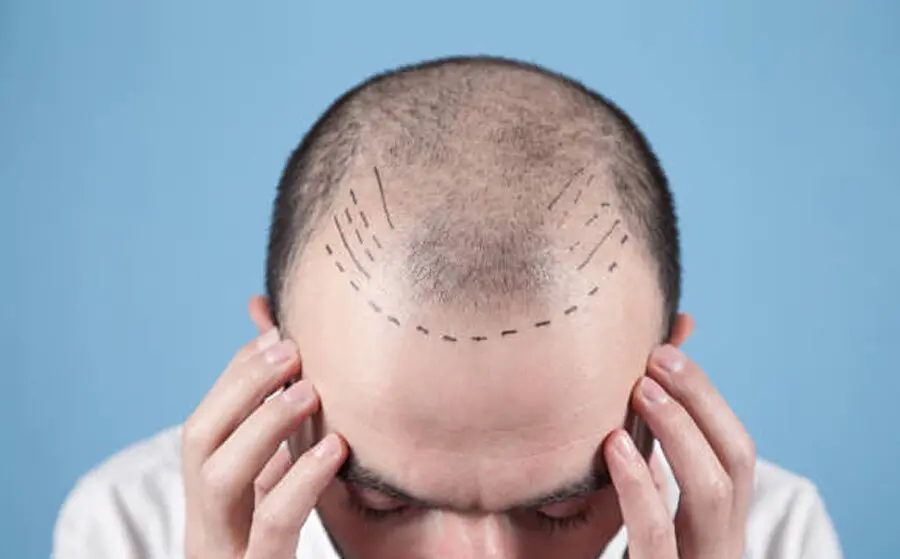 Medical Treatments For Hair Loss