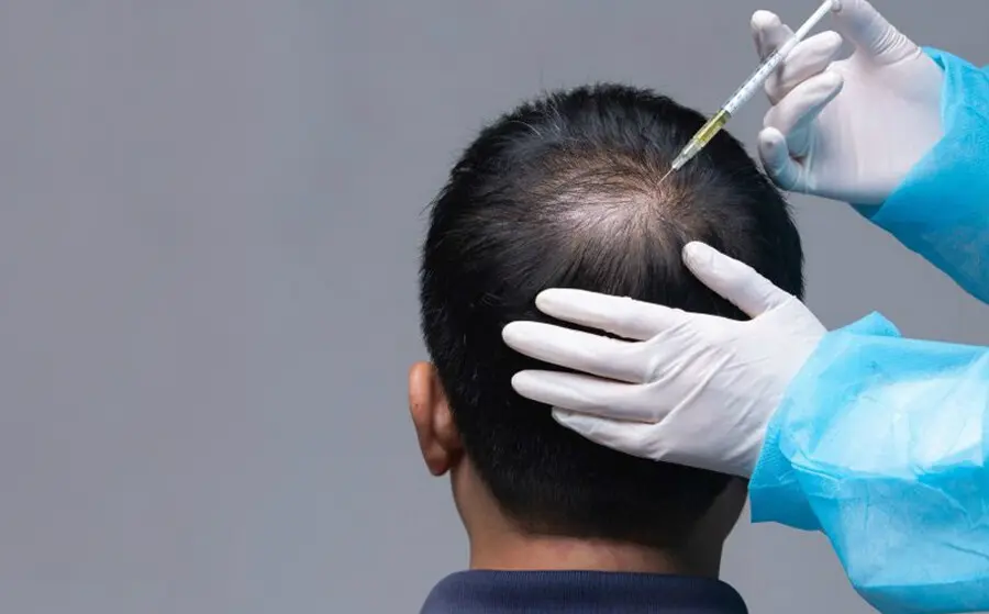 DHI Hair Transplant by Dermatologist Dr. Yusuf Topal