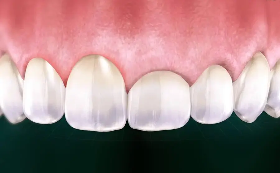Gum Contouring / Gingivectomy