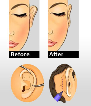 Ear Correction / Otoplasty