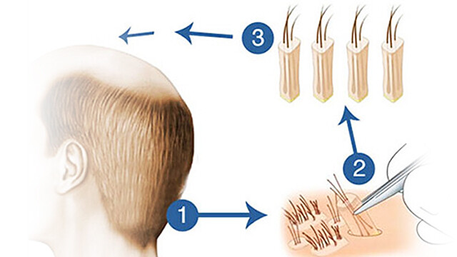 Follicular Unit Extraction (FUE) Hair Transplantation