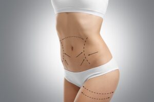 liposuction nedir?